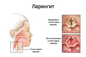 Заболевание дыхательных путей