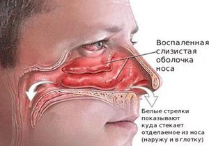 Воспаление слизистой носа