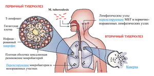 Туберкулез легких в открытой и закрытой форме
