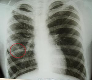 Рентгенография легких - как определить болезни на снимке