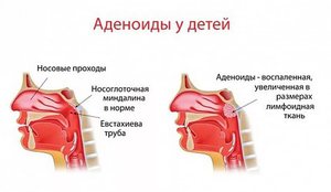 Аденоиды выявленные эндоскопией носа
