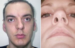 Выпрямление носовой перегородки - до и после