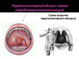 Лечение абсцесса в горле