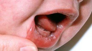 Признаки заболевания горла