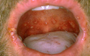 Как лечат стафилококк во рту