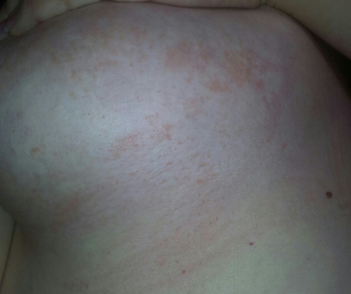 красные высыпания на груди у женщин фото 9