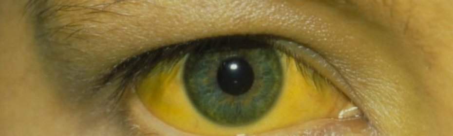 Желтый оттенок сетчатки глаза