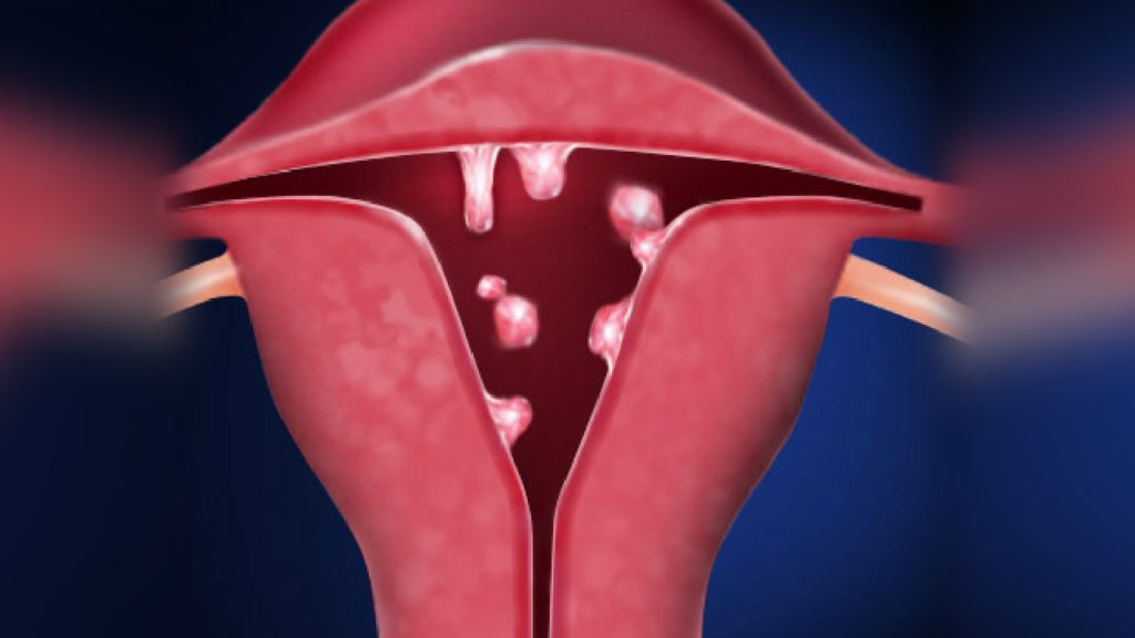 Endometritis cronica sintomas