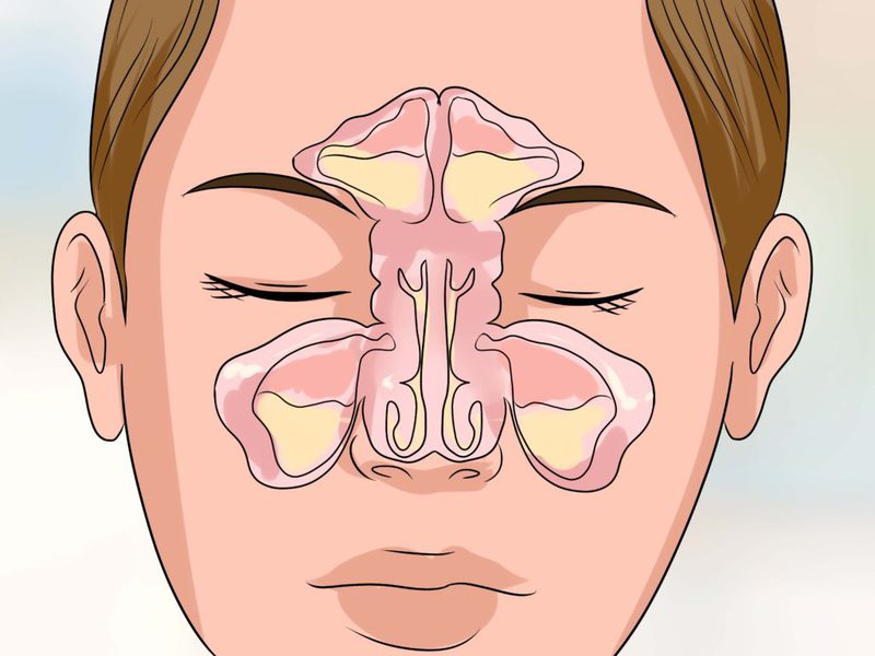 Как лечить гайморит вазотомия
