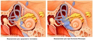 Сравнение уха здорового человека и больного