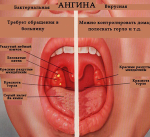 Ангина – заболевание горла